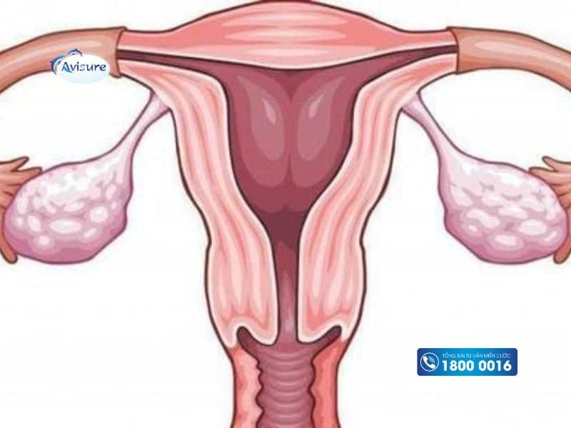 Tử cung ngả sau là gì?